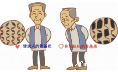 MQD-7000【骨密度仪】品牌新利18体育娱乐app菲律宾提出,预防和筛查骨质疏松症是当务之急