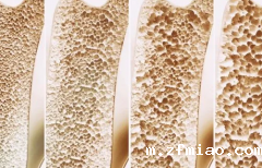 【超声骨密度仪】生产厂家国康提示老了与患骨质疏松相关的因素!