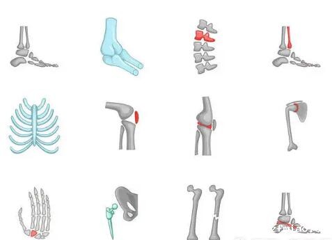 超声骨密度检测仪厂家提示你知道哪些不良习惯会损伤人体骨骼吗? 超声骨密度检测仪厂家提示你知道哪些不良习惯会损伤人体骨骼吗?