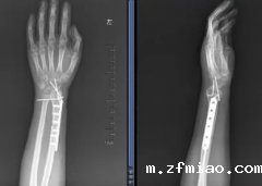 怎样选择国产胫骨桡骨骨密度仪生产厂家?