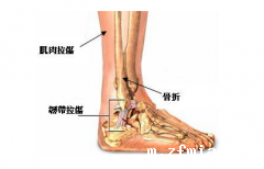 骨密度仪生产厂家解析撕脱骨折的治疗方式跟全层撕裂治疗类似