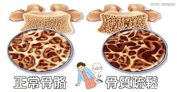 骨质疏松需要骨密度测定仪检测骨密度值(图1)