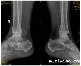 超声波骨密度检测仪厂家解释根骨骨折的类型有哪些?