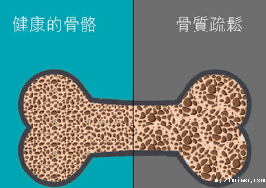 2020超声<骨密度检测仪>品牌国康提示骨质疏松患者内固定选择与置入策略！