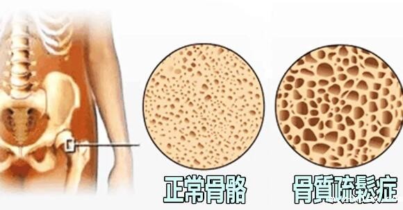 超声骨密度仪提示骨质疏松来的悄无声息测一测骨头的密度防患于未然