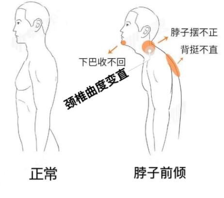 超声骨密度仪提醒颈椎前倾该怎么办？发现的问题立即调理