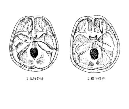 今日热点！【超声波骨密度仪生产厂家】颞骨骨折的三个症状！