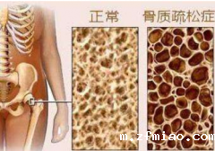 骨密度正常值是多少？超声骨密度仪生产厂家给你详细解答