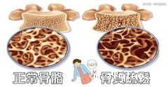 骨质疏松需要骨密度测定仪检测骨密度值