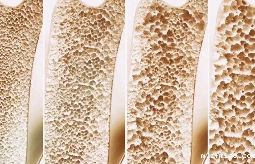 【超声骨密度仪】生产厂家国康提示老了与患骨质疏松相关的因素！