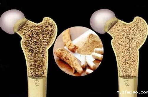 便携式超声骨密度仪解读老年人“痛”——骨质疏松症