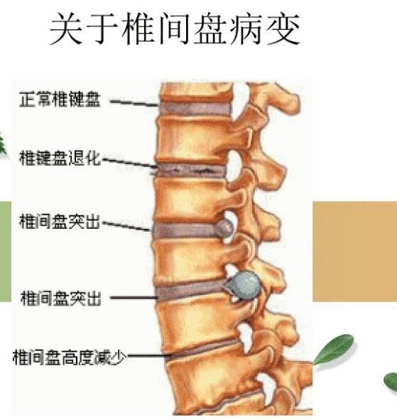 超声骨密度仪品牌国康剖析腰疼是腰椎间盘突出症仍是腰肌劳损？