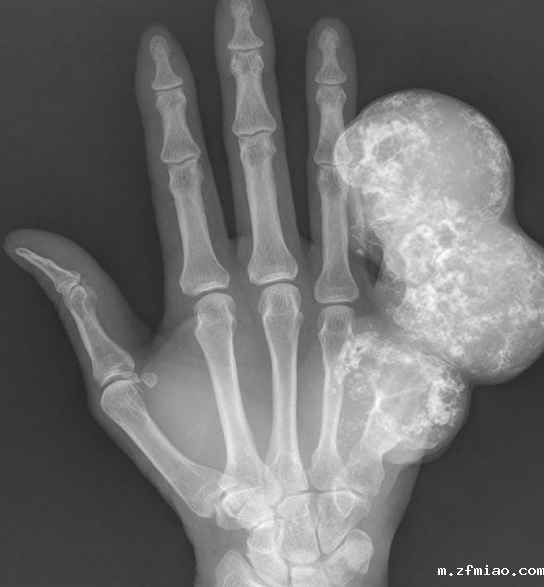 程序员手疼7年发现骨瘤!骨密度检测仪器提醒小心这些潜在的肿瘤…