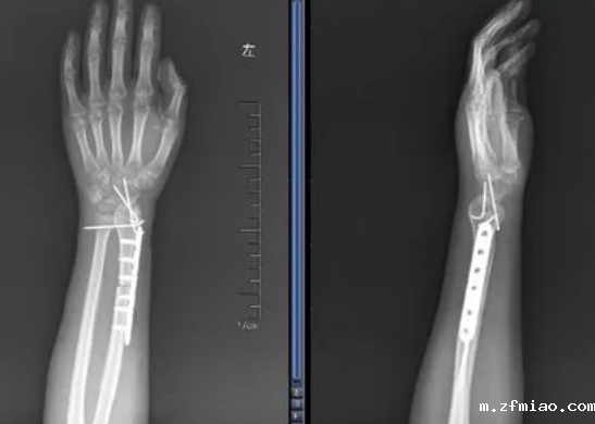 胫骨桡骨骨密度仪